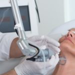 Pigmentflecken entfernen mit fraktioniertem CO2-Laser bei Dermacare