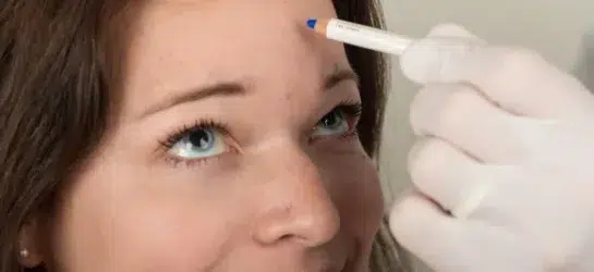 Auf dem Bild sieht man eine Patientin, die sich in einer Vorbereitungsphase für eine Botox-Behandlung bei Dermacare Wien befindet. Der Arzt markiert präzise die Stellen auf der Stirn, an denen das Botulinumtoxin injiziert werden soll, um gezielt Falten zu glätten. Diese Sorgfalt und Genauigkeit spiegeln die hohen Standards bei Dermacare wider, wo transparente Botox Preise Wien und professionelle Betreuung durch erfahrene Fachärzte gewährleistet sind.