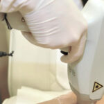 Das Bild zeigt eine professionelle Haarentfernungsbehandlung im Bereich der Bikinizone. Eine Fachkraft führt mit einem speziellen Lasergerät die Behandlung durch, wobei sie weiße Handschuhe trägt. Das Lasergerät wird präzise auf die Haut gerichtet, um unerwünschte Haare dauerhaft zu entfernen. Die Person trägt schwarze, spitzenbesetzte Unterwäsche und hat ein Bauchnabelpiercing, was den Bereich, in dem die Behandlung durchgeführt wird, betont. Diese Art der Laserhaarentfernung bei Dermacare Wien bietet eine präzise, effektive und nahezu schmerzfreie Möglichkeit, die Haut dauerhaft haarfrei zu halten.