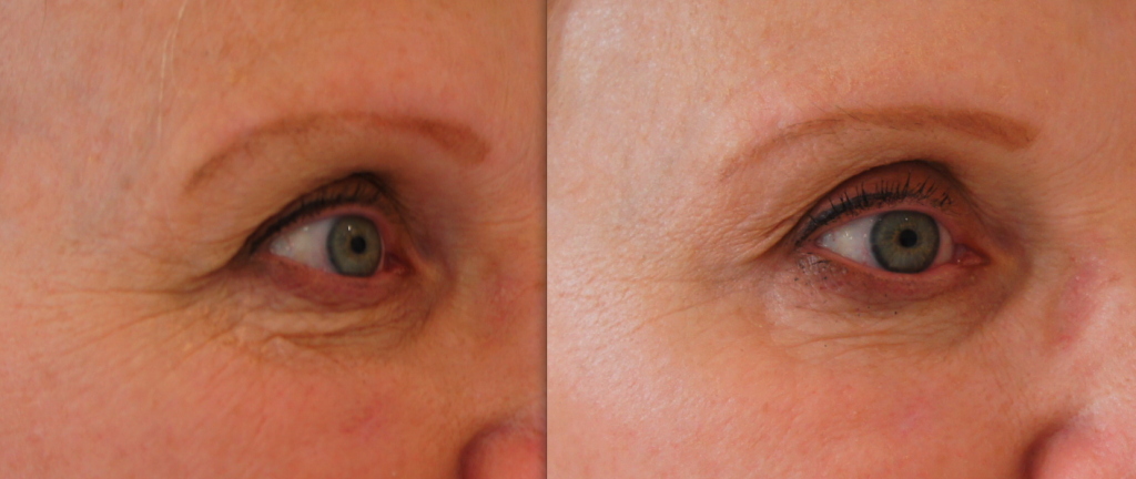 Bei dieser Dame wurden sowohl Botox als auch ein Hyaluronfiller eingesetzt