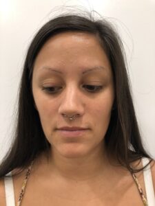 Laserbehandlung Permanent Make-up Augenbrauen bei Dermacare