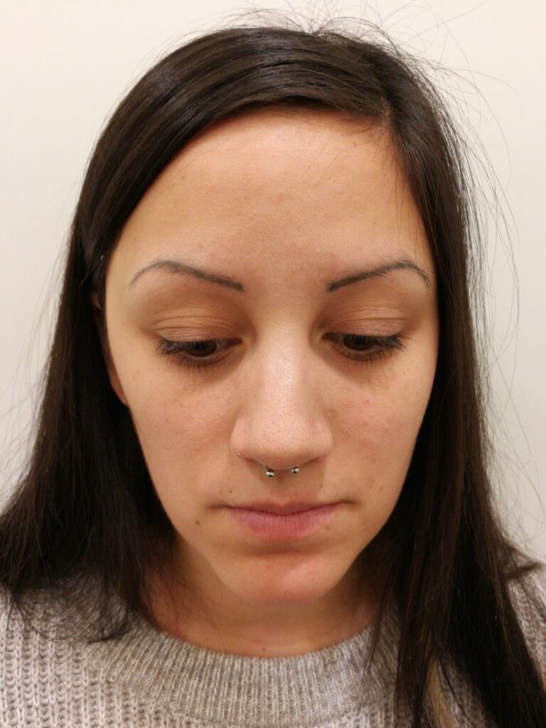 Laserbehandlung Permanent Make-up Augenbrauen bei Dermacare