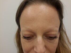 Laserbehandlung Permanent Make-up Augenbrauen bei Dermacare