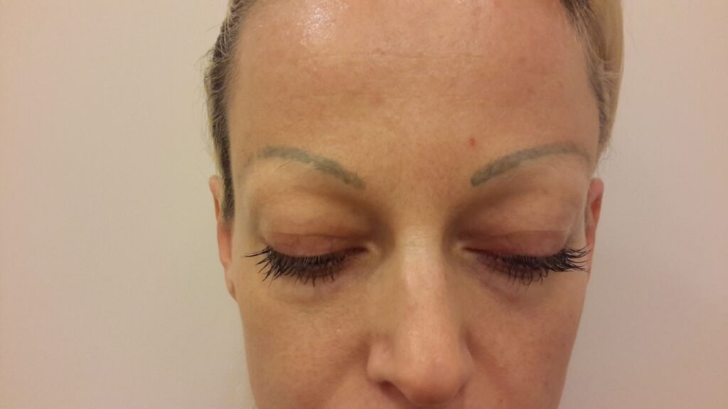 Laserbehandlung Permanent Make-up Augenbrauen bei Dermacare