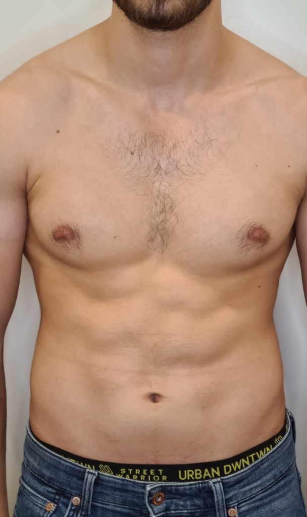 Bauch 2 Wochen nach 4. Behandlung mit SculpTight Quattro