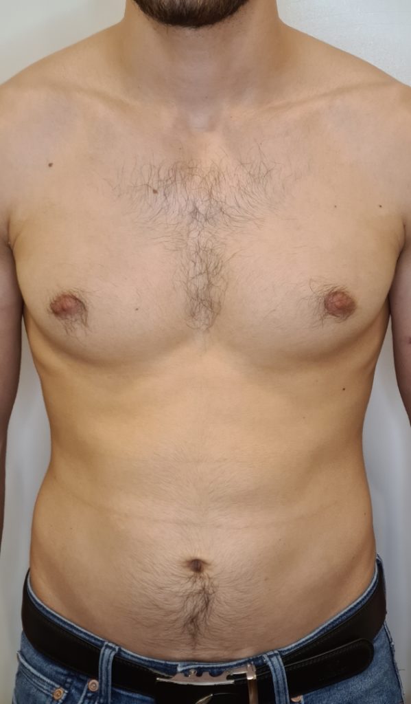 Bauch vor der 1. Behandlung mit SculpTight Quattro