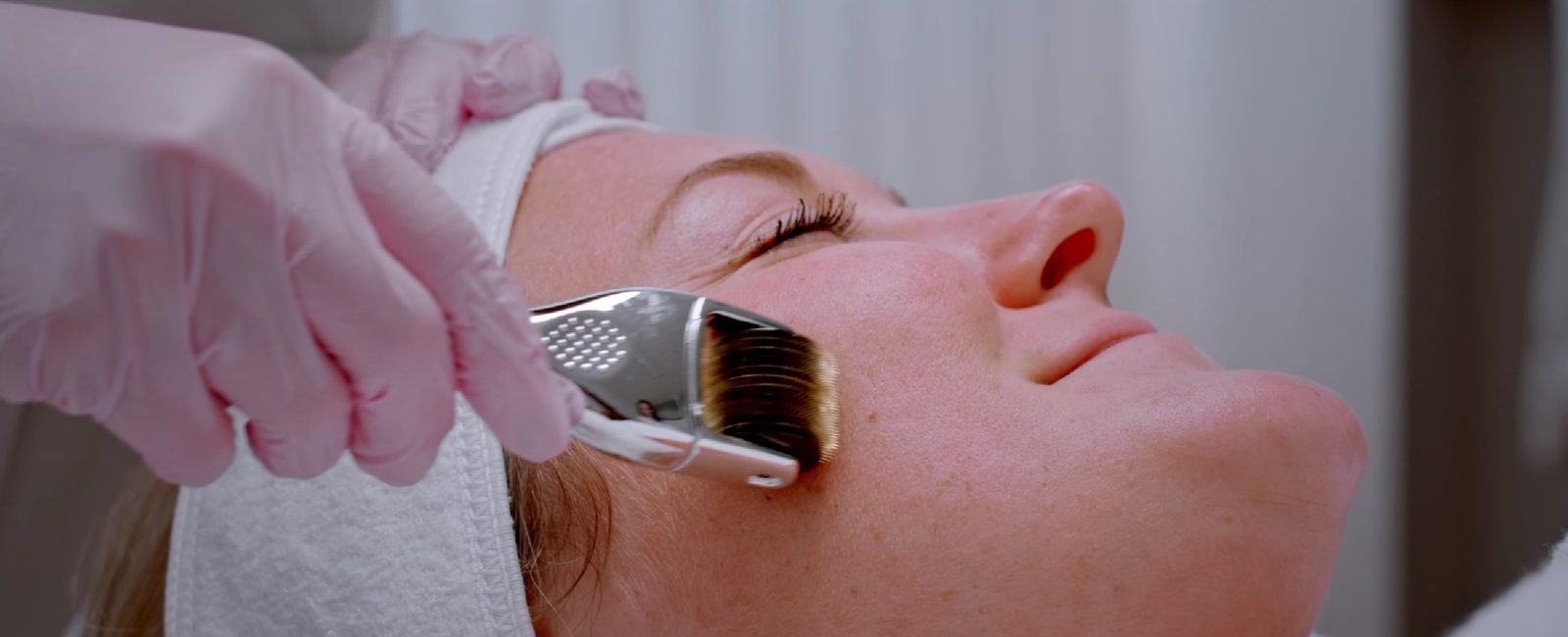 Microneedling Wien Dermaroller Behandlung bei Dermacare