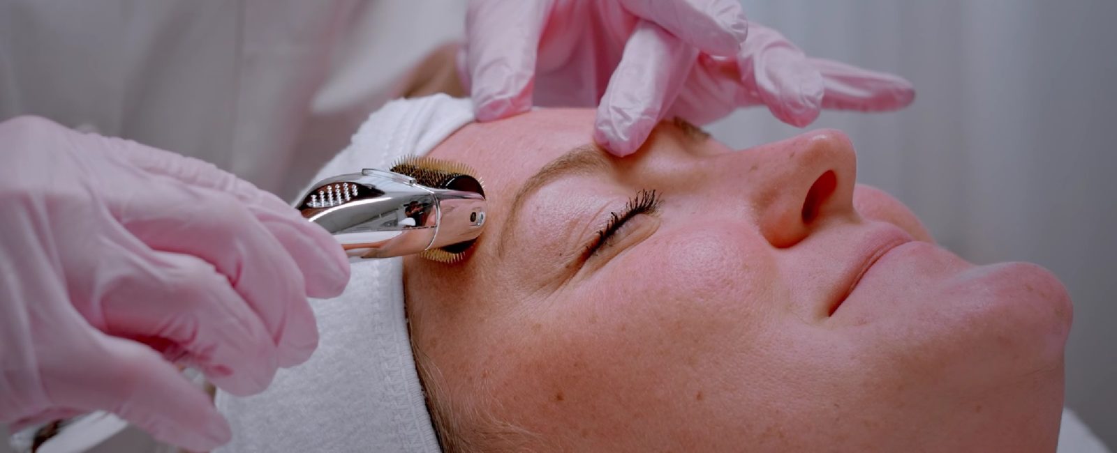 Microneedling: Dermaroller Behandlung bei Dermacare