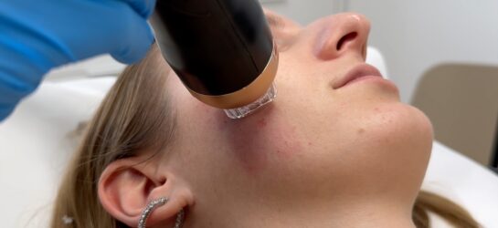 Das Bild zeigt eine Frau, die sich einer Radiofrequenz-Microneedling-Behandlung in Wien unterzieht. Ein professioneller Behandler, der blaue Handschuhe trägt, verwendet ein spezielles Gerät, um die Behandlung durchzuführen. Das Gerät, das in Nahaufnahme zu sehen ist, wird auf die Haut der Frau aufgesetzt und kombiniert feine Nadeln mit Radiofrequenzenergie. Diese Methode soll die Kollagenproduktion anregen, die Haut straffen und ihr ein jüngeres Aussehen verleihen. Die Behandlung findet in einer sauberen und professionellen Umgebung statt, was auf eine klinische oder medizinische Einrichtung hinweist. Radiofrequenz Microneedling Wien ist eine beliebte ästhetische Behandlung, um die Hautstruktur zu verbessern, Falten zu reduzieren und das allgemeine Hautbild zu verjüngen. Ebenso kann diese Behandlung mit Morpheus 8 verglichen werden.