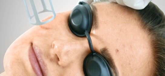 Auf dem Bild ist eine präzise dermatologische Behandlung zu sehen, bei der moderne Lasertechnologie im Gesichtsbereich angewendet wird. Die Patientin trägt eine spezielle Schutzbrille, während ein geschulter Behandler mit medizinischen Handschuhen den Laser präzise über die Haut führt. Diese Art der Behandlung wird auch bei Dermacare Wien eingesetzt, um eine effektive Hautverjüngung zu erzielen und die natürliche Kollagenproduktion anzuregen. Durch die gezielte Laserenergie lassen sich nicht nur feine Linien und Hautunebenheiten reduzieren, sondern auch eine sanfte Hautstraffung erreichen. Das Bild vermittelt einen professionellen, hygienischen und medizinisch hochwertigen Behandlungsablauf.