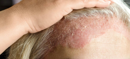 Das Bild zeigt eine gereizte, gerötete Kopfhaut mit sichtbaren Hautschuppen – typische Anzeichen für seborrhoische Ekzeme. Diese Hauterkrankung tritt häufig an talgdrüsenreichen Bereichen wie der Kopfhaut, Stirn oder im Gesicht auf und führt zu schuppender Haut, Rötungen und Juckreiz. Bei Dermacare Wien werden seborrhoische Ekzeme professionell diagnostiziert und individuell behandelt. Moderne dermatologische Therapien helfen, die Entzündung zu lindern, die Hautbarriere zu stärken und das Hautbild nachhaltig zu verbessern.