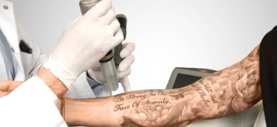 Auf diesem Bild sieht man einen Mann der eine Tattooentfernung Wien erhaltet. Er möchte ein Tattoo am Arm entfernen lassen, dabe hält ein Fachpersonal einen Laser sorgfältig über die betroffene Stelle.