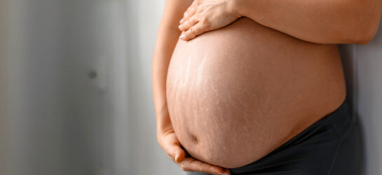Auf dem Bild sieht man den Bauch einer schwangeren Frau, der deutlich sichtbare Schwangerschaftsstreifen am Bauch zeigt. Die feinen, hellen Linien sind typische Dehnungsstreifen durch Schwangerschaft, die durch das schnelle Dehnen der Haut entstehen. Viele Frauen wünschen sich nach der Geburt, diese Schwangerschaftsstreifen entfernen zu lassen – etwa durch moderne Behandlungen bei Dermacare in Wien.