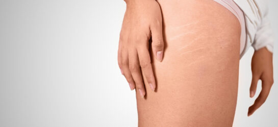 Das Bild zeigt einen Oberschenkel mit sichtbaren Dehnungsstreifen, während eine Hand sanft auf der Haut liegt. Die feinen Linien sind typisch für Dehnungsstreifen, die zum Beispiel durch schnelles Wachstum, Schwangerschaft oder Gewichtsschwankungen entstehen. Eine beliebte Methode, um das Hautbild zu verbessern, ist Schwangerschaftsstreifen vorbeugen oder anschließend Microneedling bei Dehnungsstreifen. Im Schönheitsinstitut Dermacare Wien werden solche Behandlung und Beratungen angeboten, um die Hautregeneration anzukurbeln. Wer also seine Dehnungsstreifen reduzieren möchte, kann mit Dermacare gute Ergebnisse erzielen.