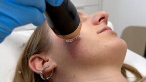 Radiofrequenz Microneedling Dermacare Wien