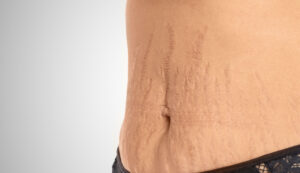 dehnungsstreifen lasern dermacare wien dehnungsstreifen entfernen