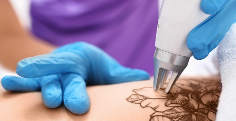 Artikel tattoo entfernen methoden zur tattooentfernung behandlung dermacare wien