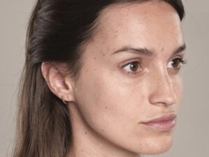 Faltenunterspritzung Lippen vergroessern Wien bei Dermacare e1702472019761 866x650 1