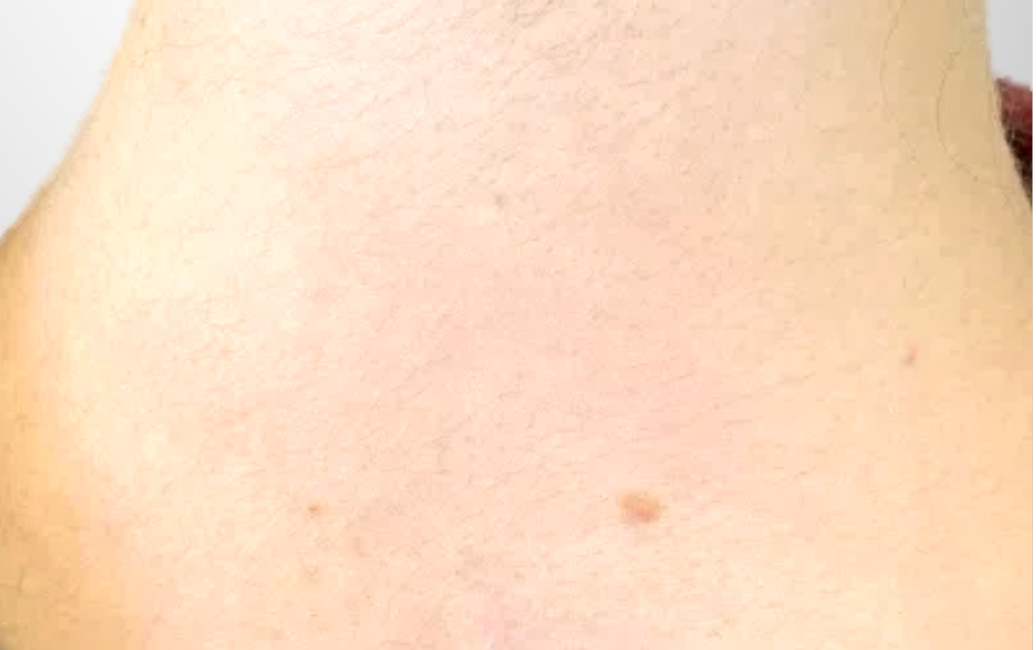 Tattooentfernung Vorher-Nachher Bilder Kleeblatt nachher bild tattooentfernung frau Nacken dermacare wien 1036x650 1