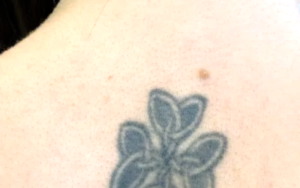 Tattooentfernung Vorher-Nachher Bilder Kleeblatt vorher bild tattooentfernung frau Nacken dermacare wien 1036x650 1