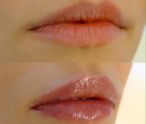 Lippen aufspritzen Wien Dr Olga Latowa Dermacare 1010 Wien Vorher Nachher 2 768x650 1