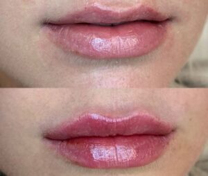 Lippen aufspritzen Wien Dr Olga Latowa Dermacare 1010 Wien Vorher Nachher 768x650 1