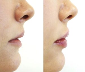 Lippenkorrektur Wien Dr Olga Latowa Dermacare 1010 Wien Vorher Nachher 768x650 1