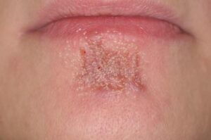 Narben entfernen bei dermacare 1010 wien nach zwei behandlungen