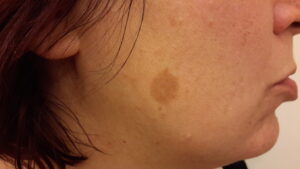Pigmentfleck gesicht vorher