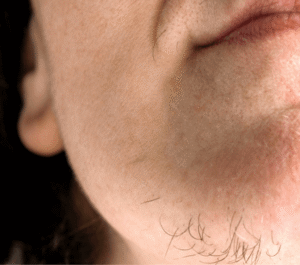 Vorher bild2 nadelepilation damenbar dermacare