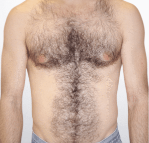 Vorher bilde laserhaarentfernung brust dermacare