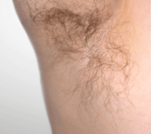 Vorher laserhaarentfernung achsel dermacare