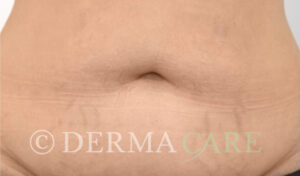 bauch schwangerschaftsstreifen dehnungsstreifen nach microneedling 1106x650 1