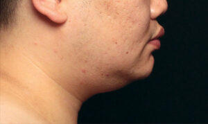 coolsculpting kinn nachher Dermacare Wien mann