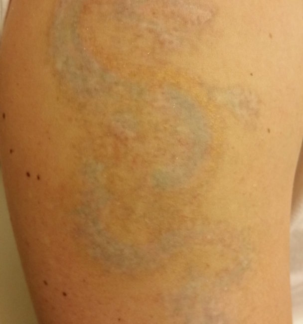Tattooentfernung Vorher-Nachher Bilder dermacare mehrfarbig tattooentfernung oberarm nachher 608x650 1