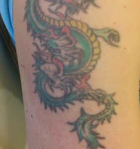 Tattooentfernung Vorher-Nachher Bilder dermacare mehrfarbig tattooentfernung oberarm voher 608x650 1