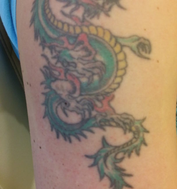 Tattooentfernung Vorher-Nachher Bilder dermacare mehrfarbig tattooentfernung oberarm voher 608x650 1