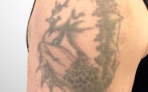 Tattooentfernung Vorher-Nachher Bilder drache vorher bild tattooentfernung arm dermacare wien 1036x650 1