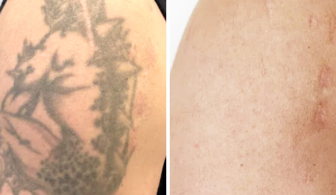 Tattooentfernung Vorher-Nachher Bilder drache vorher nachher bild tattooentfernung arm dermacare wien 1120x650 1