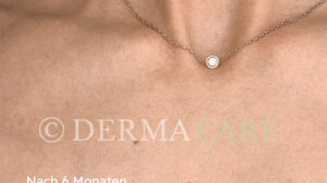 hautverjuengung stammzellen dekollete nachher bild stammzellentherapie 1163x650 1