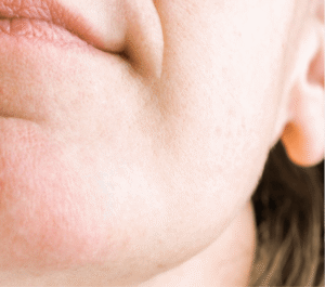 nachher bild nadelepilation damenbar dermacare 2