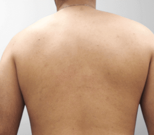 nachher bilder laserhaarentfernung dermacare ruecken