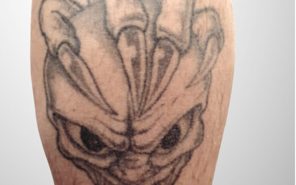 Tattooentfernung Vorher-Nachher Bilder teufel vorher bild tattooentfernung wadel 1036x650 1