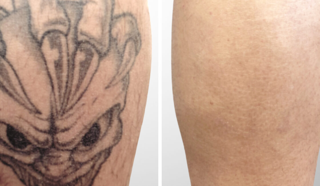 Tattooentfernung Vorher-Nachher Bilder teufel vorher nachher bild tattooentfernung wadel 1120x650 1