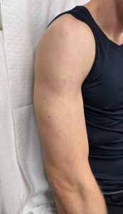 Tattooentfernung Vorher-Nachher Bilder Hier sieht man wie das vollflächige schwarze Tattoo am Arm vollständig verschwunden ist. Es ist ein nachher Bild nachdem es weggelasert wurde bei dermacare wien. Tattooentfernung nachher Bild. Die haut ist makellos rein, ohne jeliche Farbrückstände.