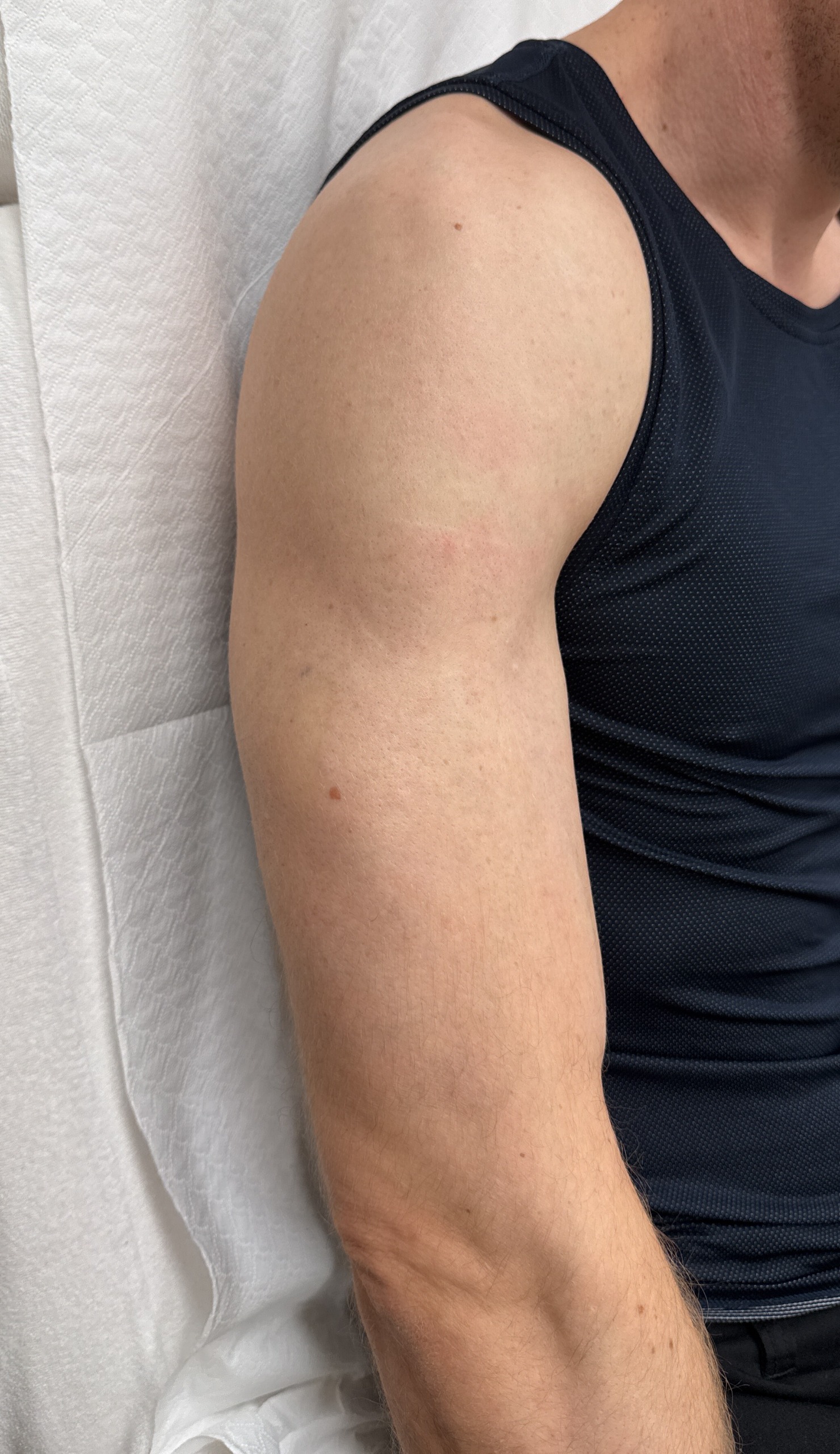 Tattooentfernung Vorher-Nachher Bilder Hier sieht man wie das vollflächige schwarze Tattoo am Arm vollständig verschwunden ist. Es ist ein nachher Bild nachdem es weggelasert wurde bei dermacare wien. Tattooentfernung nachher Bild. Die haut ist makellos rein, ohne jeliche Farbrückstände.