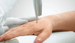 Das Bild zeigt eine Nahaufnahme einer Behandlung zur Entfernung von Altersflecken auf dem Handrücken. Ein medizinisches Gerät, ein CO2-Laser, wird präzise auf die Haut der Hand gerichtet, während ein Facharzt in weißen Handschuhen die Behandlung durchführt. Diese Methode ist eine effektive Lösung, um Altersflecken zu entfernen, insbesondere auf empfindlichen Stellen wie den Händen. Der CO2-Laser trägt gezielt pigmentierte Hautschichten ab, um die Haut zu glätten und Altersflecken zu reduzieren. Die Behandlung bietet eine moderne Antwort auf die Frage: „Was tun gegen Altersflecken auf dem Handrücken?“